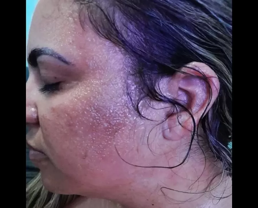 Violência – Em Ji-Paraná marido joga água fervendo no rosto da esposa durante discussão